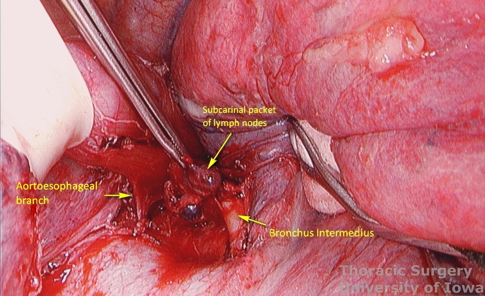 Esophagectomy for esophageal carcinoma thoracoscopic three incisions McKeown subcarinal lymph nodes packet dissection with bronchus intermedius protected