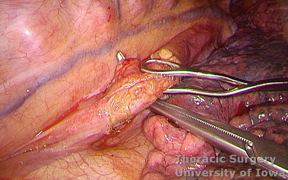 Esophagectomy for esophageal carcinoma thoracoscopic three incisions dissection around  esophagus 