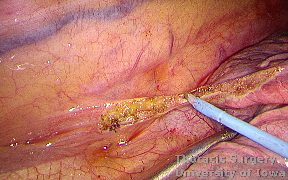 Esophagectomy for esophageal carcinoma thoracoscopic three incisions inferior pulmonary ligament divided