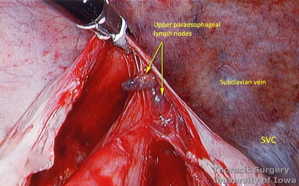 Esophagectomy for esophageal carcinoma thoracoscopic upper paraesophageal lymph nodes removed as part of lymphadenectomy subclavian vein and superior vena cava