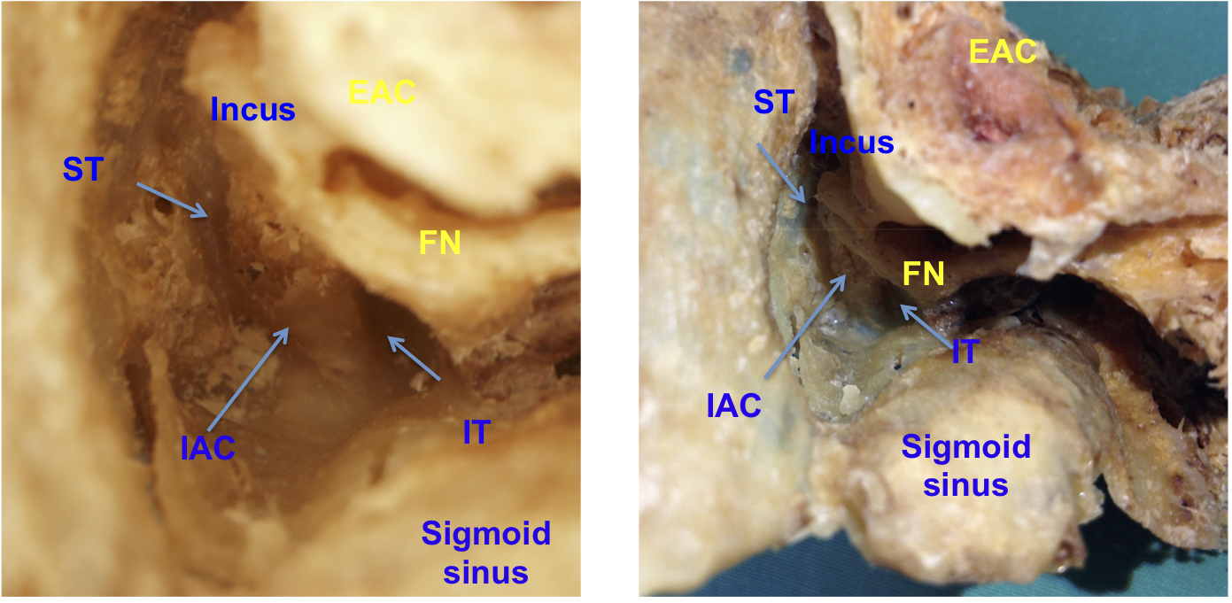 scutum temporal bone