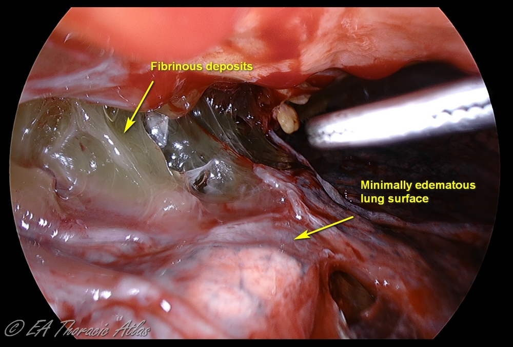 Fibrinous deposits on the lung surface develop during the early exudative phase of the empyema