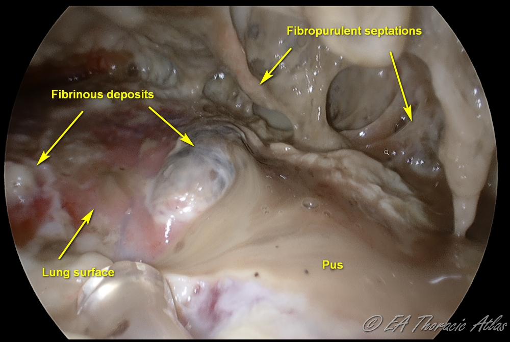 Fibropurulent phase of the empyema (stage II) with purulent effusion, extensive debris and intrapleural loculation 