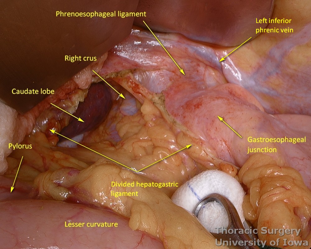 Hepatogastric and hepatoduodenal  ligaments are divided to enter a lesser sac