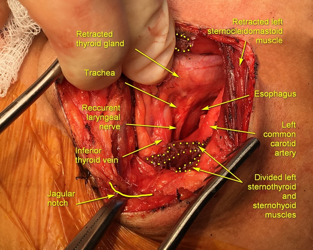 Relevant anatomy during left neck exploration for trauma