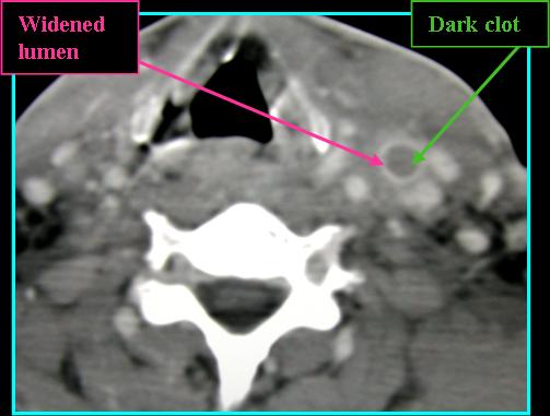 Jugular Vein Thrombosis - Radiology | Iowa Head and Neck Protocols