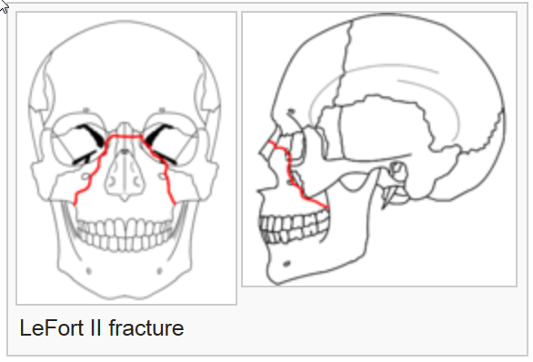 lefort fracture iv