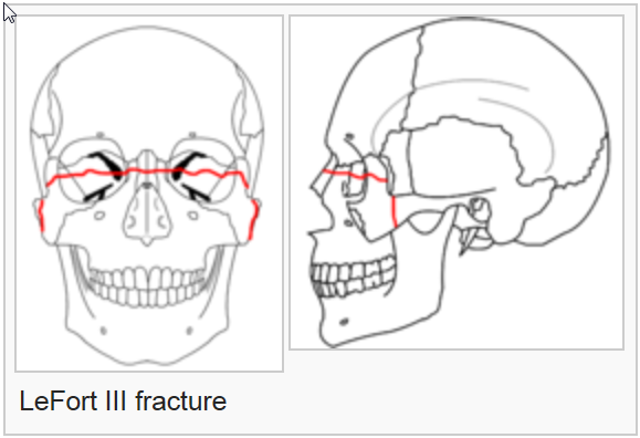 le fort fracture case report