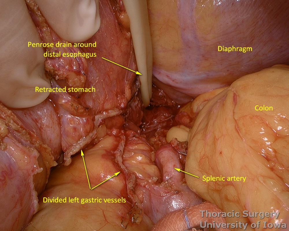 Left gastric vessels staple line is demonstrated during esophagectomy