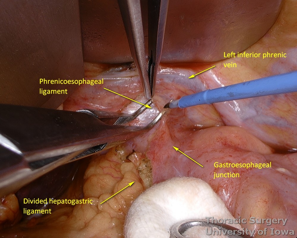 esophagectomy Peritoneum is incised around the esophageal hiatus