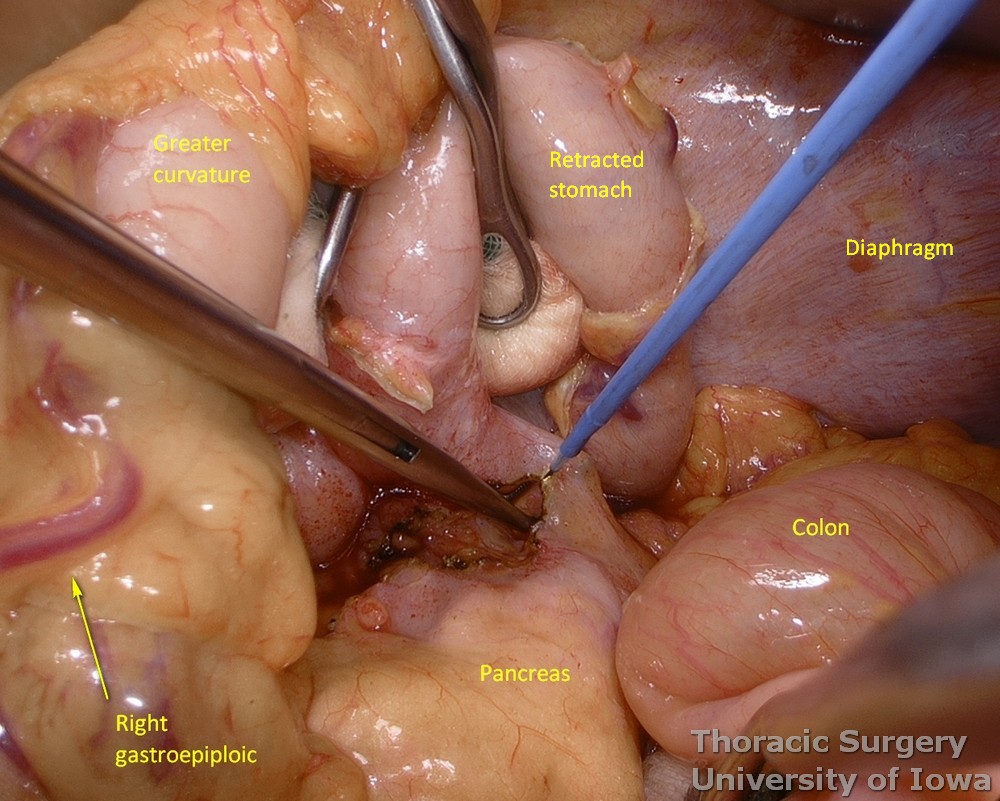 Peritoneum is incised for dissection of the left gastric vessels and lymphadenectomy