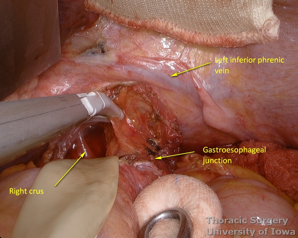 Phrenoesophageal ligament and postradiation adhesions are divided to enter the mediastinum