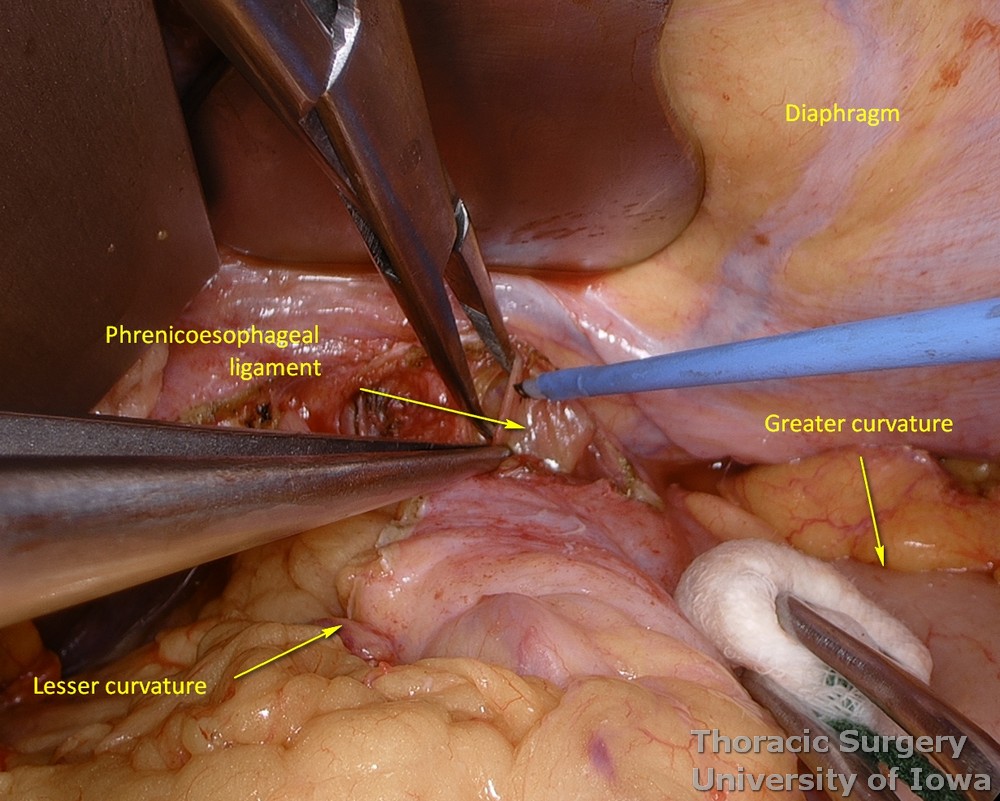 Phrenoesophageal ligament is divided circumferentially to enter the mediastinum during esophagectomy
