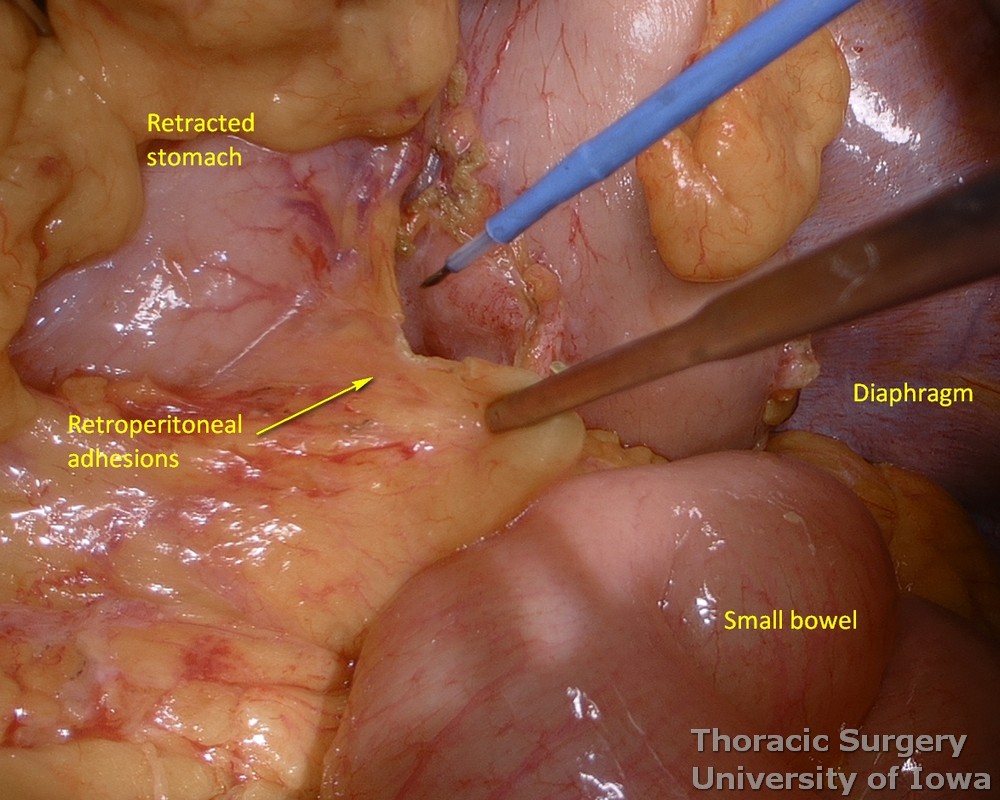 osterior adhesions of the stomach are divided