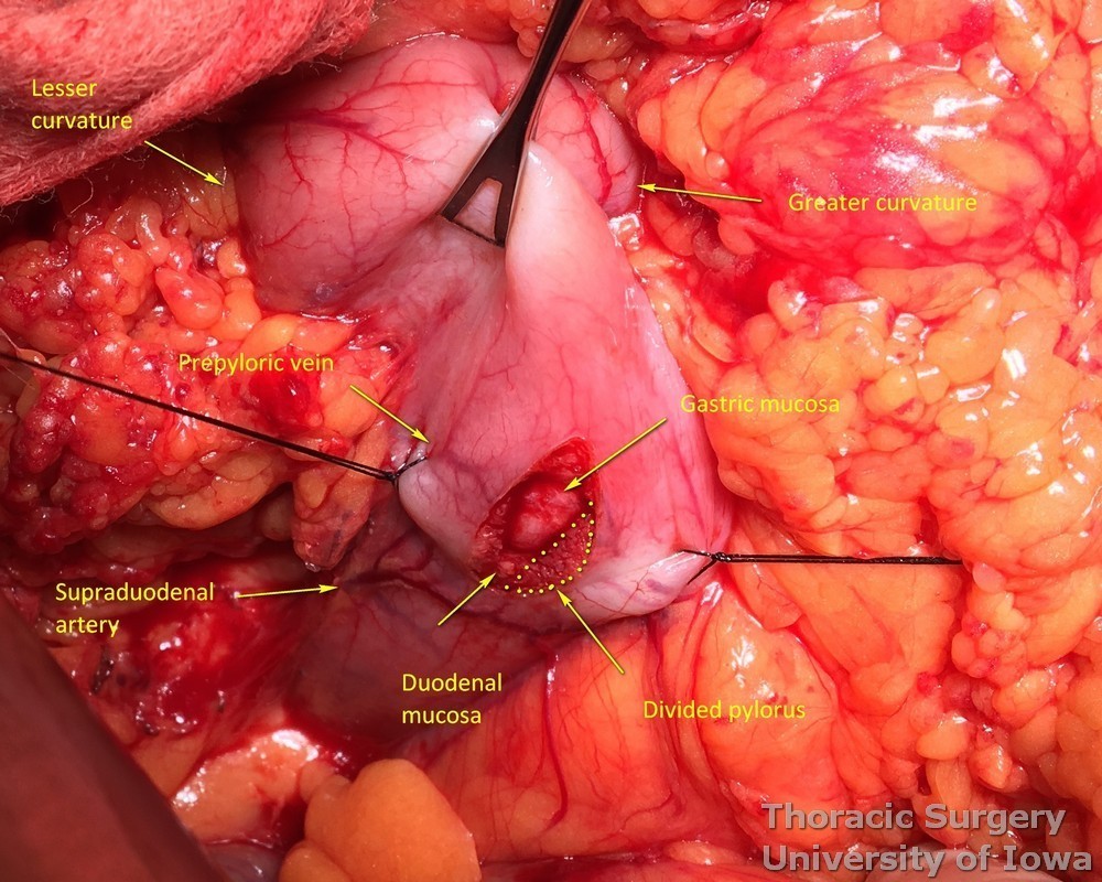 Pyloromyotomy during esophagectomy