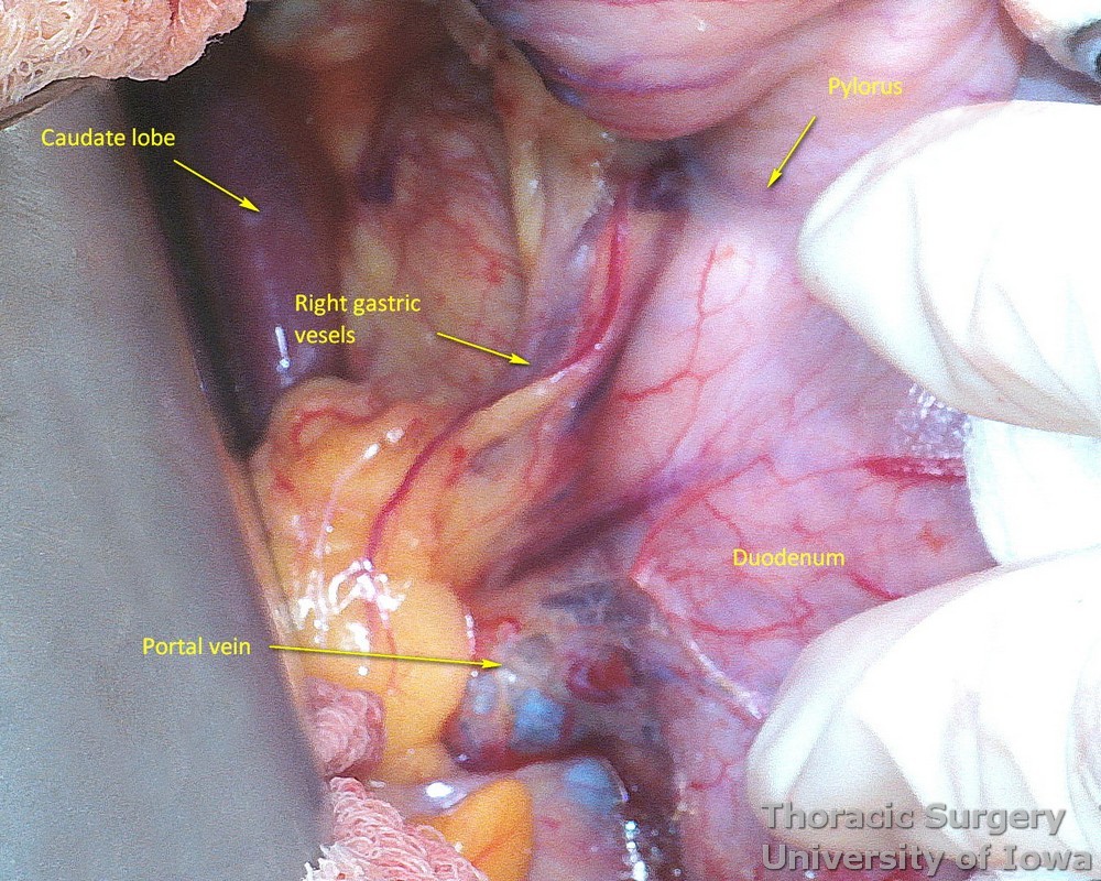 Right gastric vessels are preserved during mobilization of the stomach if possible, during esophagectomy