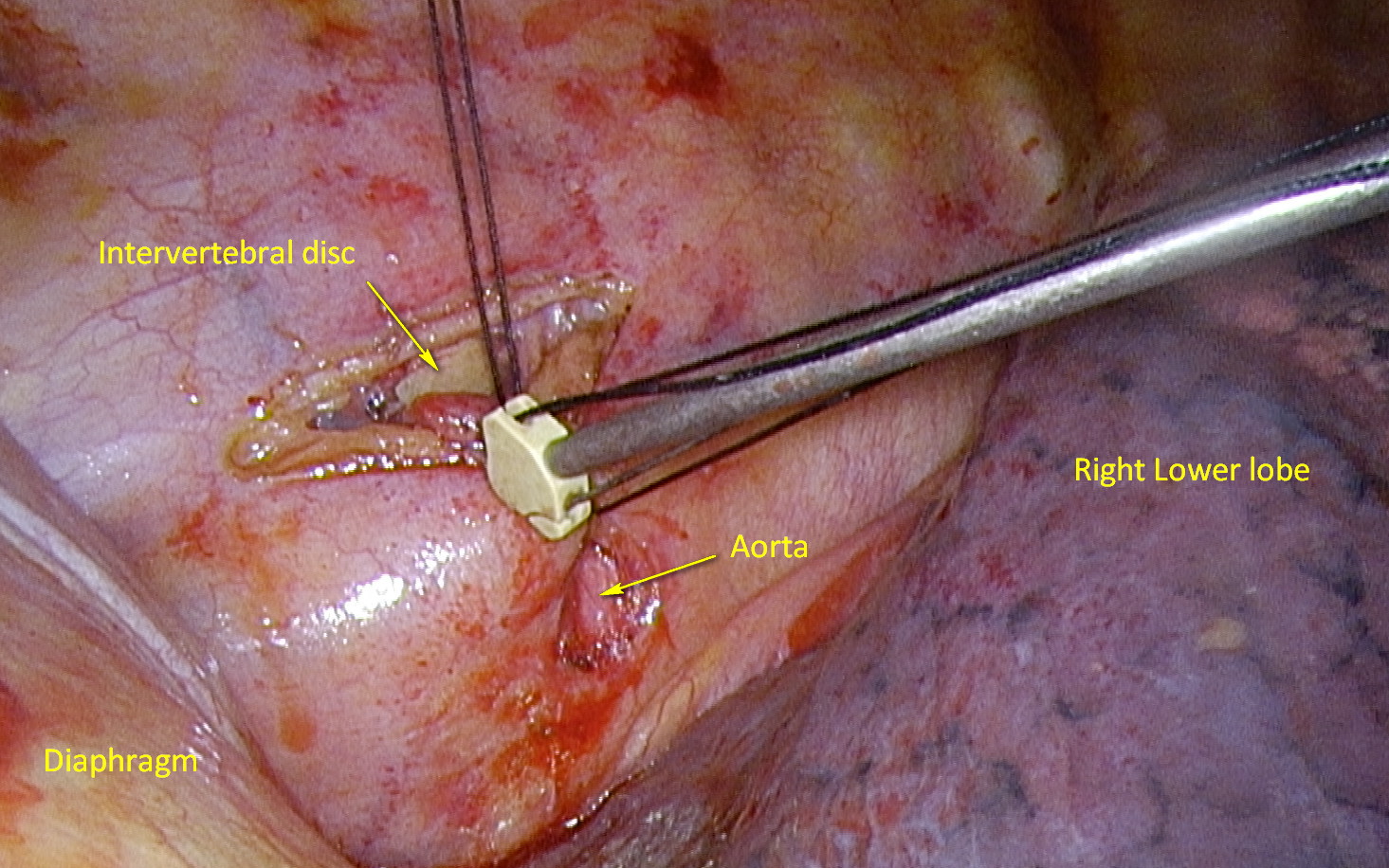 Ties are secured using knot-pusher to complete mass ligation of the thoracic duct