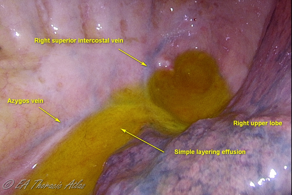 Simple layering parapneumonic effusion