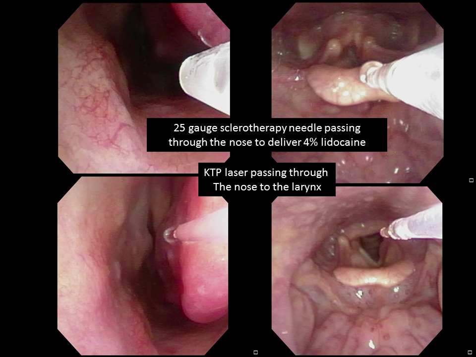 Laryngeal papillomatosis surgeon. Respiratory papillomatosis laryngoscopy