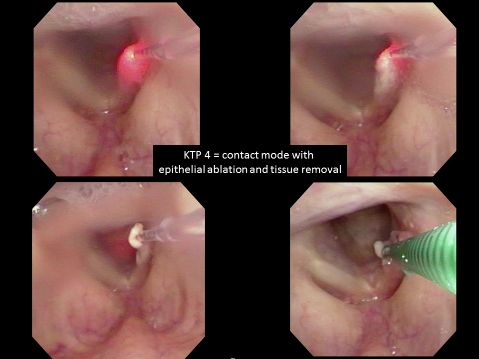 Surgical treatment for laryngeal papilloma, Treatment of laryngeal papillomatosis