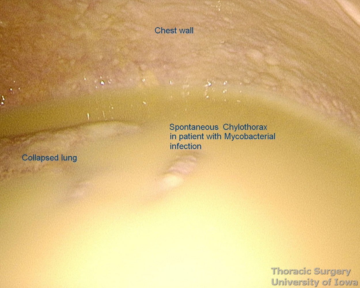 Spontaneous chylothorax in a patient with an atypical mycobacteria infection and positive AFB growth in the chyle culture