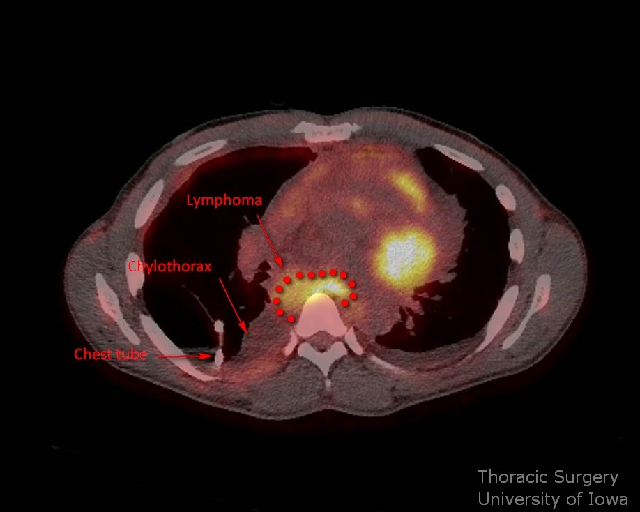 Spontaneous chylothorax in the setting of B cell lymphoma