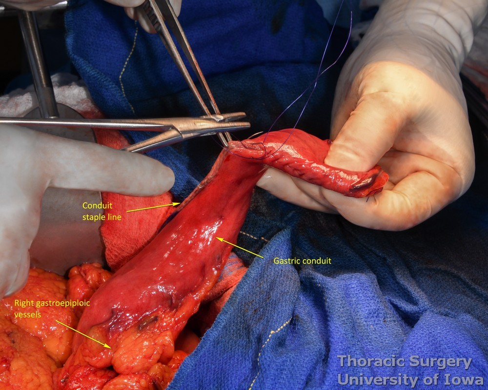 Esophagectomy_Staple line is oversewn with seromuscular running suture with care not to travel far between bites to avoid shortening the gastric conduit