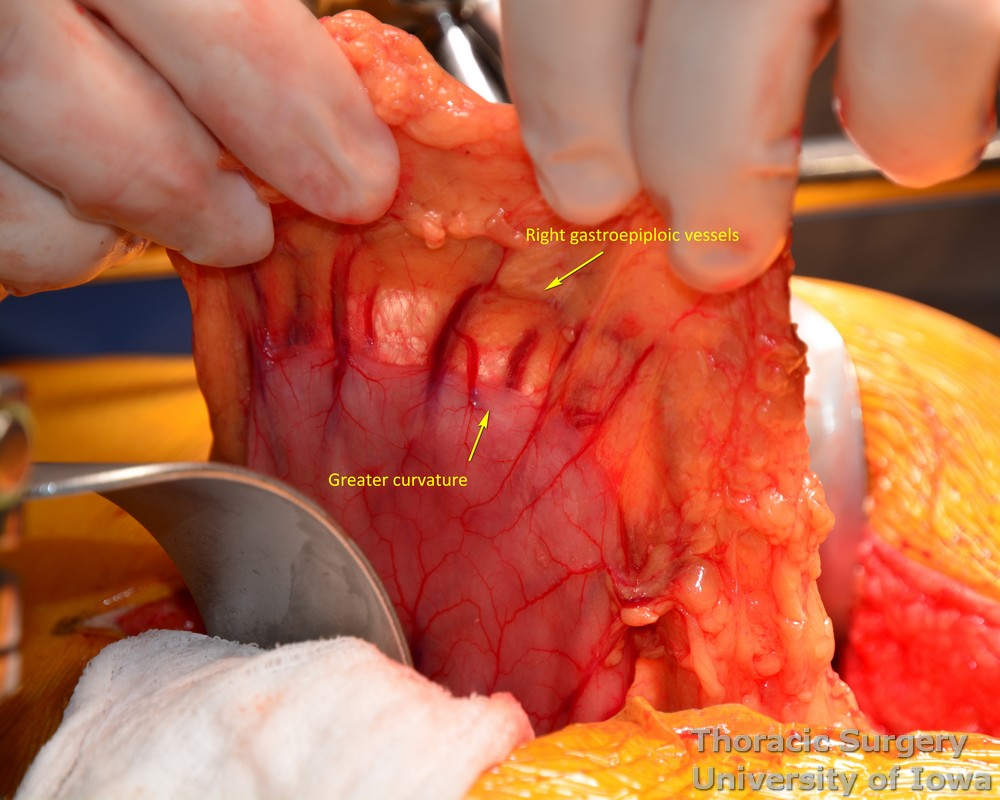 Stomach and right gastroepiploic pedicle are handled very gently through out the esophagectomy
