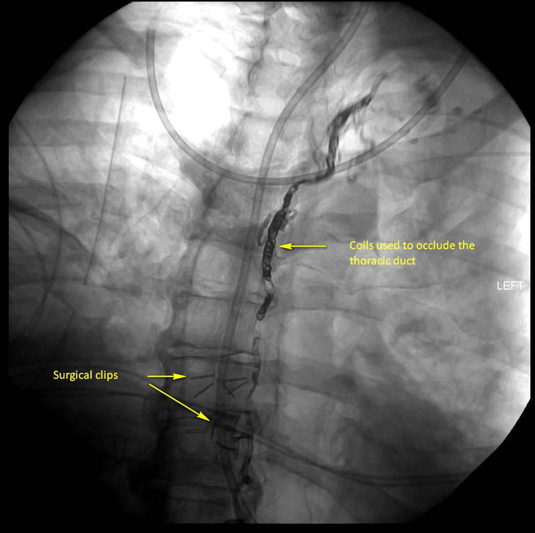 Thoracic Duct Chylothorax