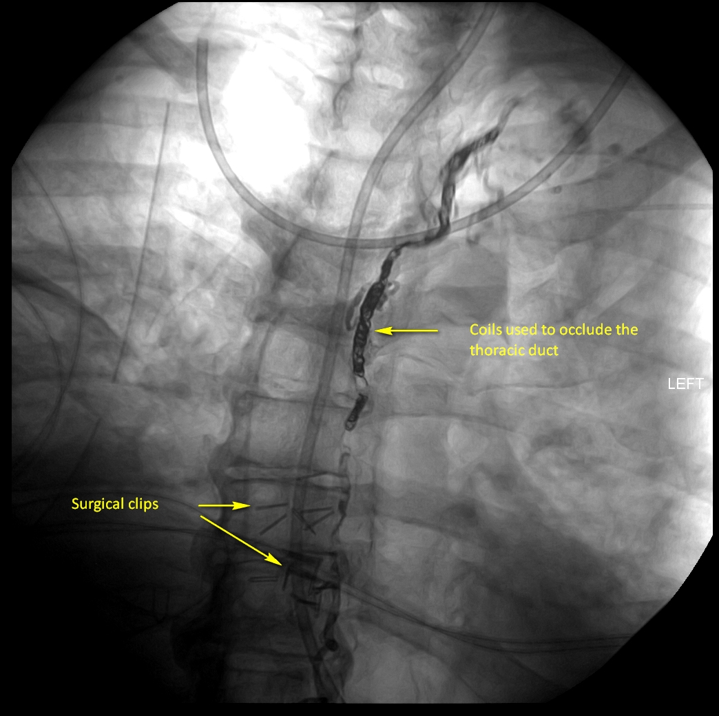 Thoracic duct ligation for chylothorax failed in an outside institution and successful IR embolization