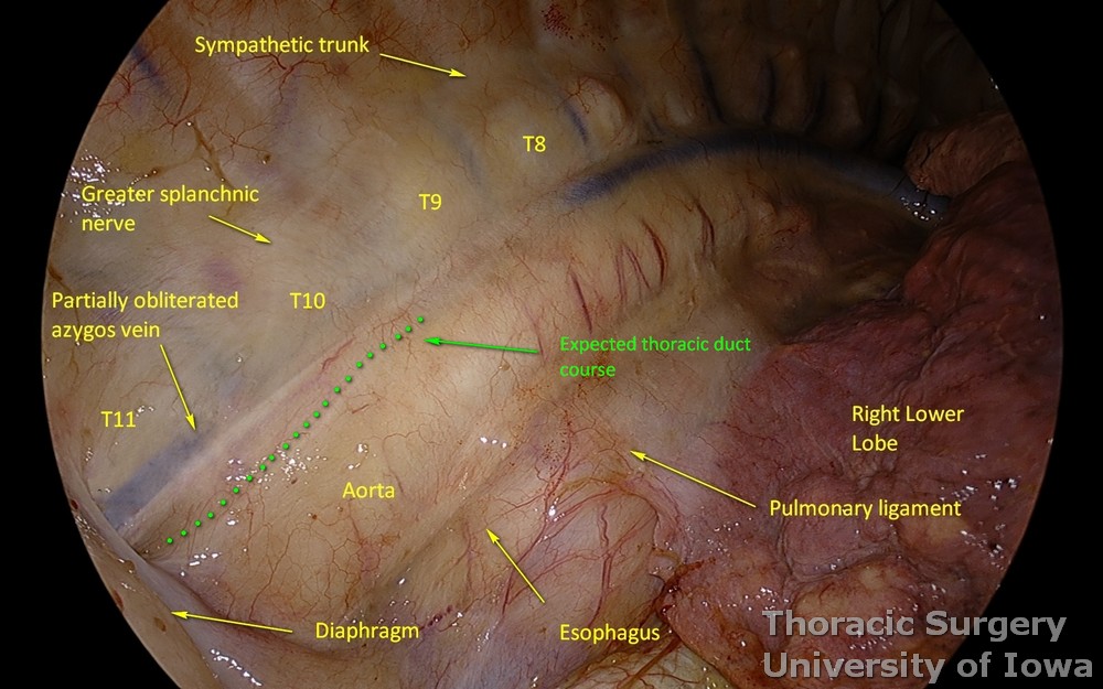 Thoracoscopic view of a spontaneous chylothorax in a patient with a metastatic carcinoma. Relevant right chest anatomy is depicted. 