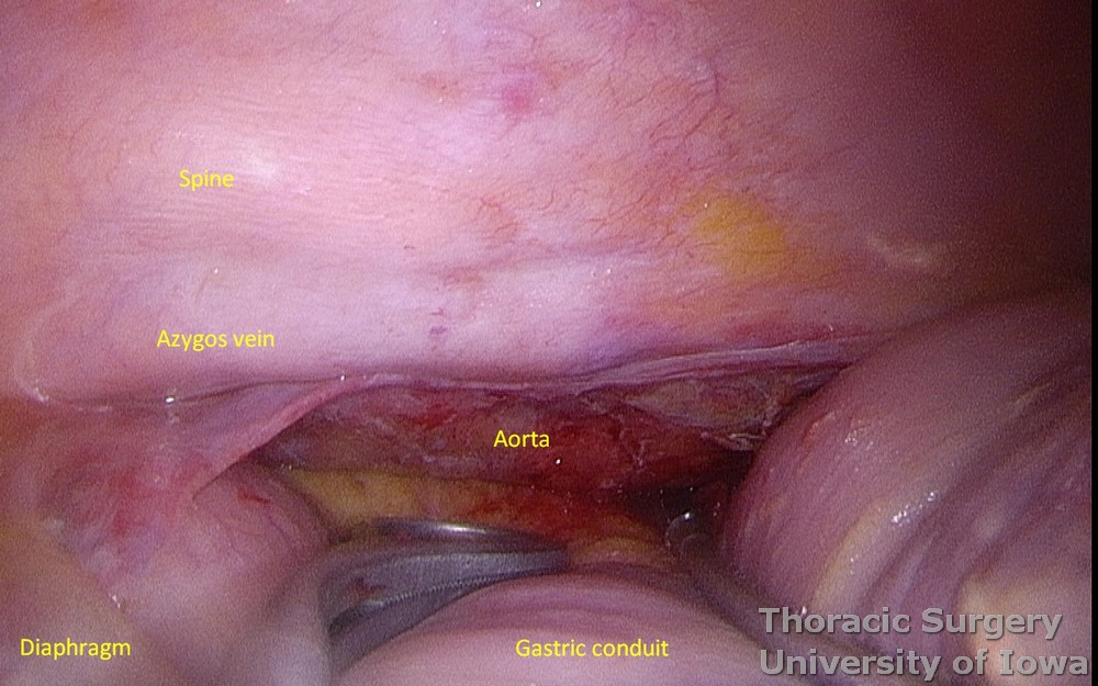 Thoracic duct ligation for chylothorax thoracoscopically VATS with a gastric conduit retracted 