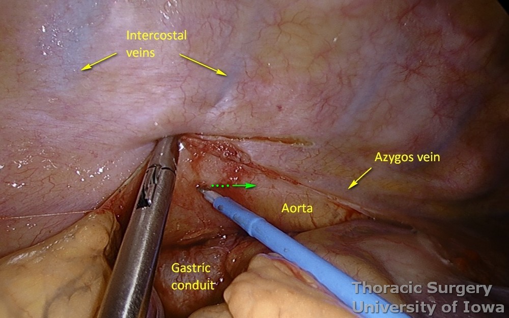 Thoracic duct ligation parietal pleura incised along aorta