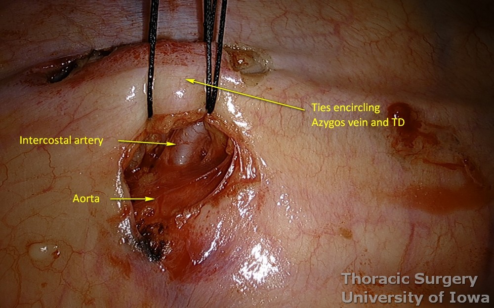 Thoracic duct ligation for chylothorax . Protect intercostal arteries