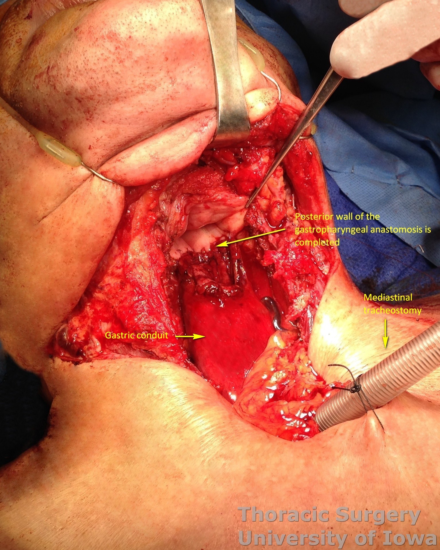 Hand sewn gastropharyngeal anastomosis after total laryngectomy