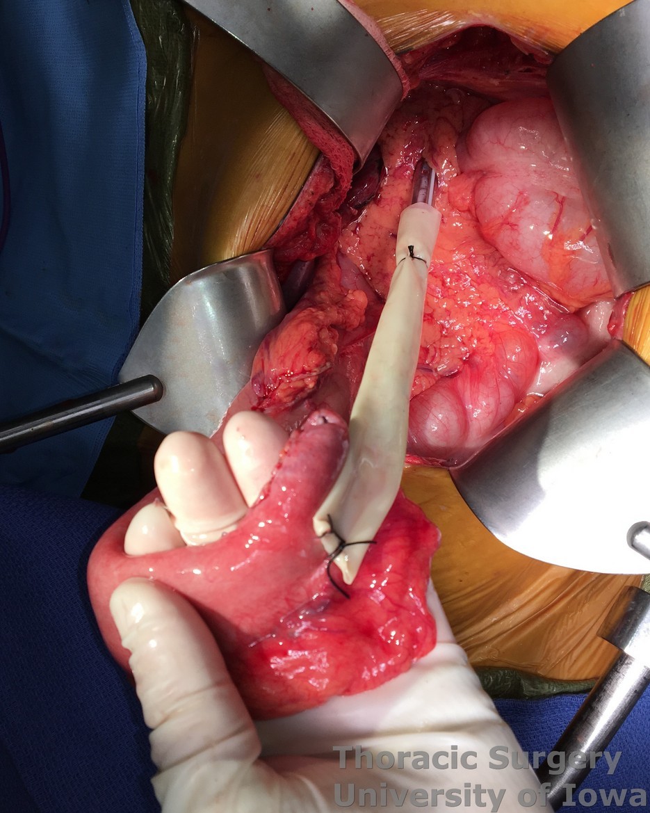 Transhiatal Esophagectomy for carcinoma Saratoga Sump used to deliver the conduit from the abdomen  into neck incision