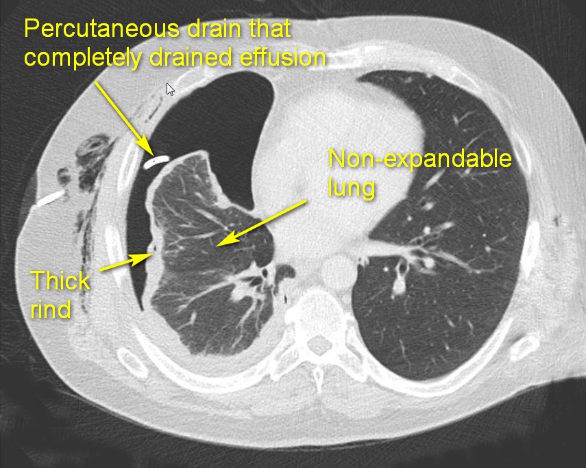 Trapped lung by a thick fibrotic rind preventing its expansion after empyema was completely drained with a percutaneous drain