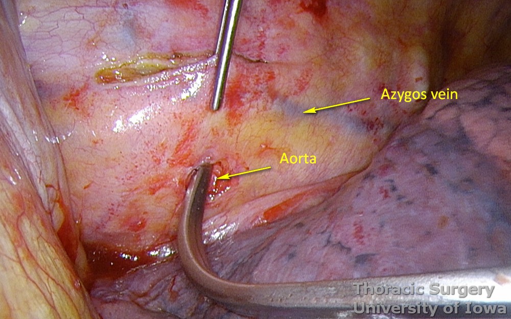 Thoracic duct ligation for chylothorax thoracoscopically VATS with dissection just above aorta