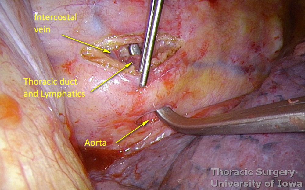 Thoracic duct ligation for chylothorax thoracoscopically VATS with dissection just above aorta to the spine