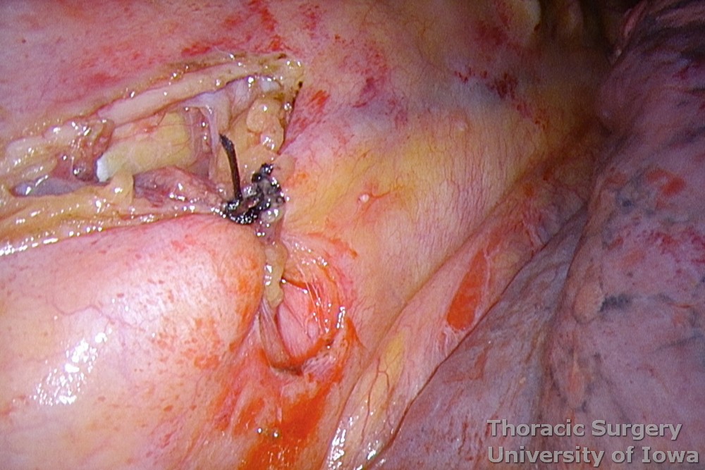 Thoracic duct ligation for chylothorax. •	After tying the ligatures, NO division of the duct is performed