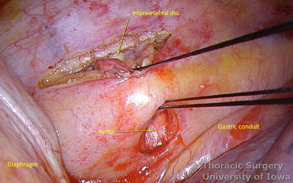 azygos vein, TD, potential lymphatic branches, parietal pleura are encircled with a silk ties