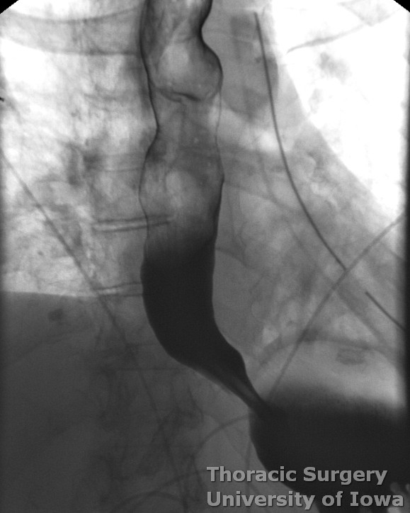 Postoperative esophagram after midesophageal diverticulectomy and esophageal myotomy demonstrating a patent esophageal lumen without leak and rapid empting into the stomach