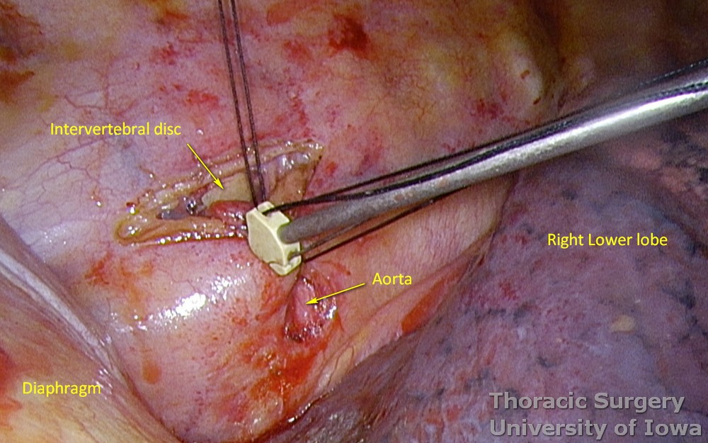 Thoracic duct ligation for chylothorax, Silk sutures are tied using a knot pusher. 