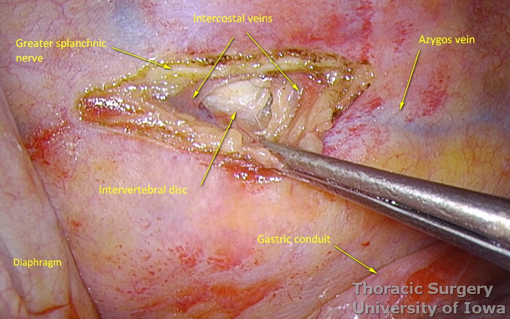 Thoracid dict ligation parietal pleura incised just above the azygos vein and spine exposed.jpg