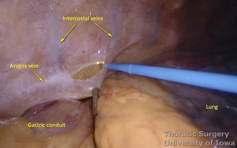parietal pleura incised just above the azygos vein