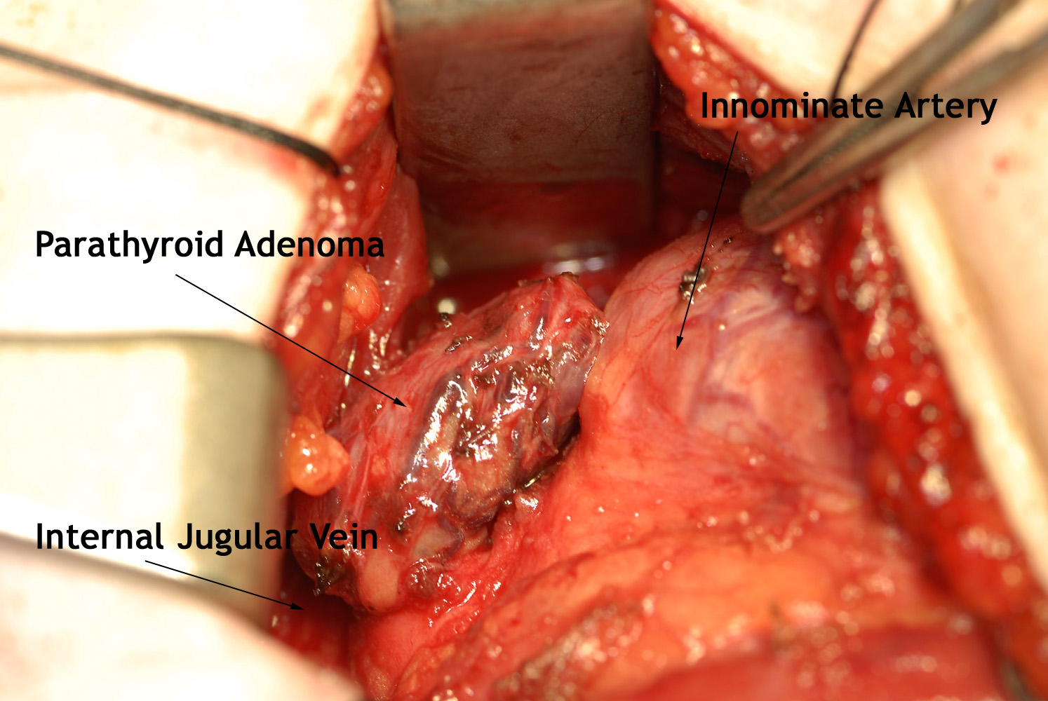 Parathyroidectomy | Iowa Head and Neck Protocols