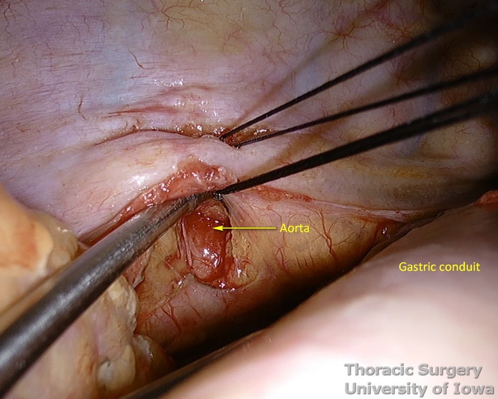 Thoracic duct ligation for chylothorax thoracoscopically VATS all  tissues between aorta spine and azygos vein are dissected 