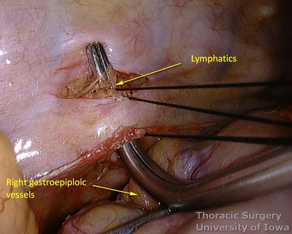 Thoracic duct ligation for chylothorax 