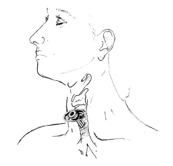 tracheostomy1