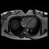3T Cardiac Images - Axial FIESTA non gated Human Chest TE = 1.2 TR = 3.2